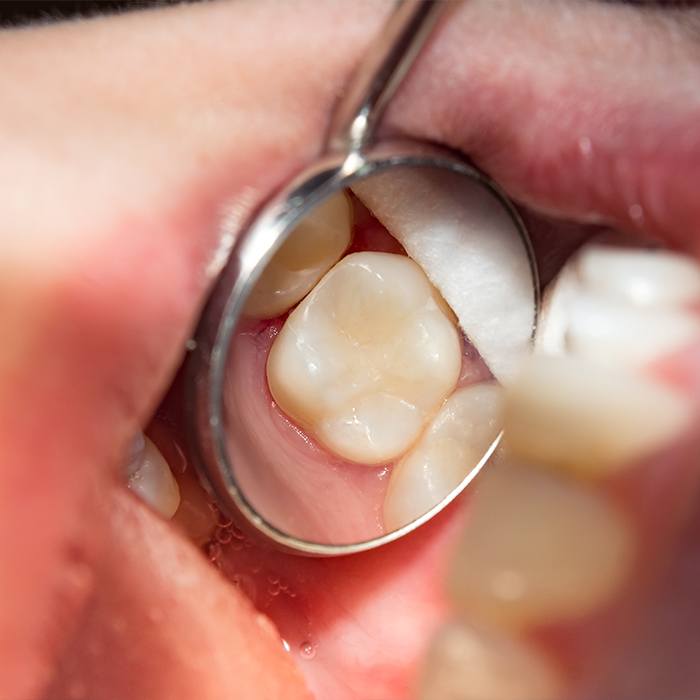 Closeup of smile after dental sealant placement