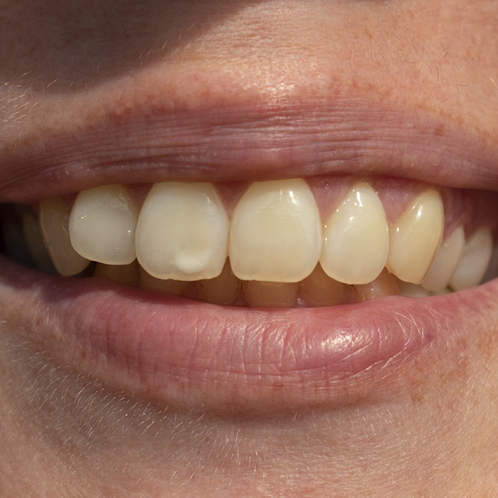 Closeup of smile with tooth discoloration