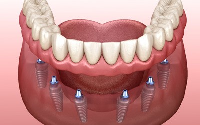Illustration of implant dentures in Grove City