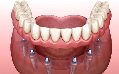 the final restoration being put on dental implants in Grove City