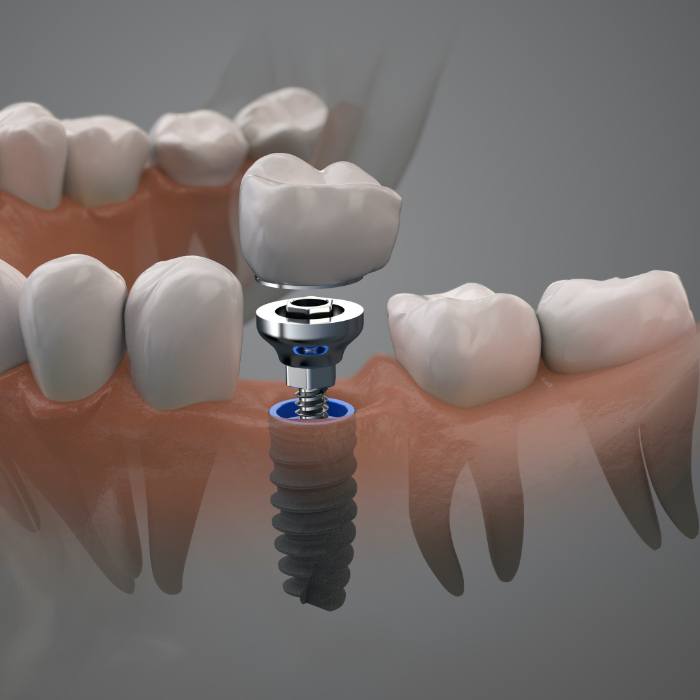 Components of an animated dental implant supported dental crown