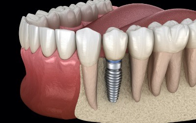Animated smile with a dental implant supported dental crown in place