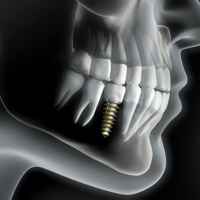 Aniamted smile with dental implant supported dental crown in place