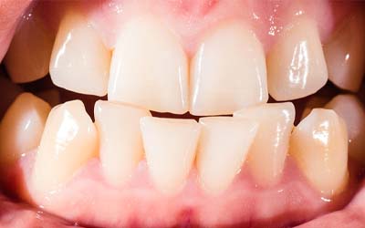 misaligned teeth showing the factors that affect the cost of Invisalign in Grove City