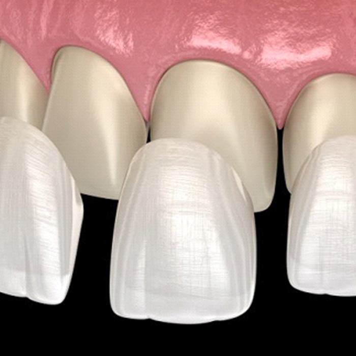 several veneers being placed over the upper teeth